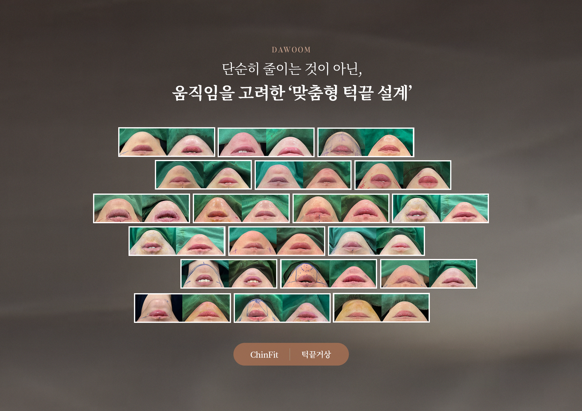 턱끝거상 상세02