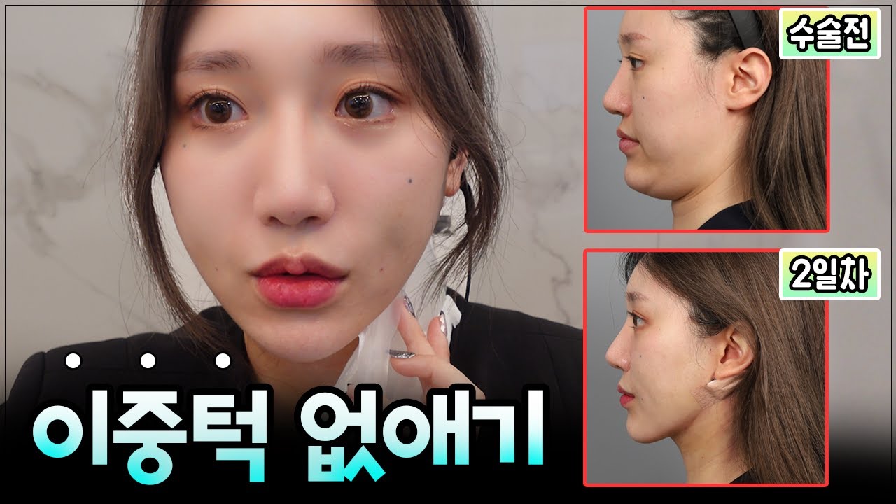 상담실장이 직접 브이리프트를 받아본다면?