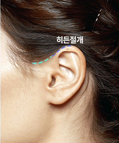 절개 A타입