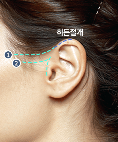 절개 A타입