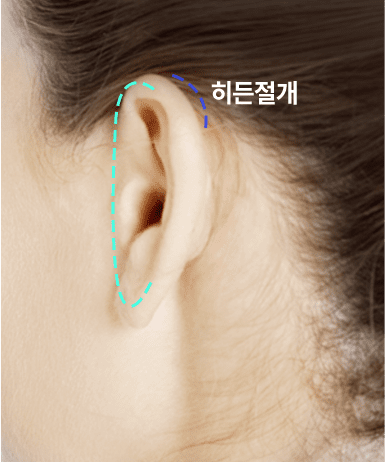 절개 A타입